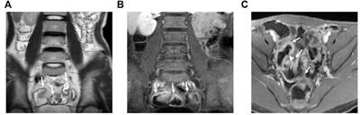 Magnetically Guided Capsule Endoscopy and Magnetic Resonance Enterography in Children With Crohn’s Disease: Manifestations and the Value of Assessing Disease Activity